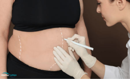 Turkey’s Bariatric Brilliance: Choosing the Right Procedure for You Picture6